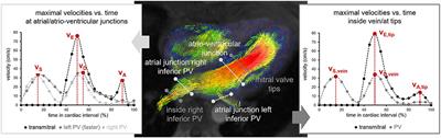 Left atrial acceleration factor as a magnetic resonance 4D flow measure of mean pulmonary artery wedge pressure in pulmonary hypertension